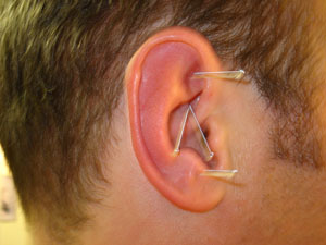 picture of man receiving microsystems acupuncture to his ear