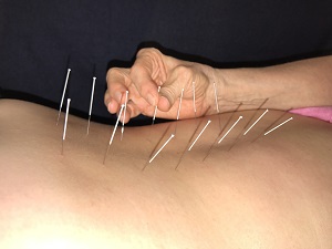 Spinal Acupuncture